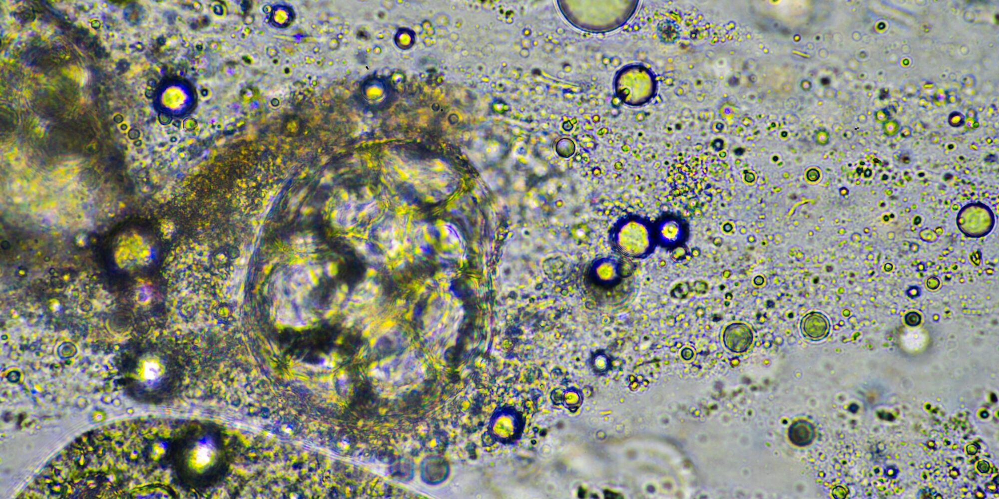 Coughing up mucus and phlegm from a chest infection from a virus and bacteria infection, looking at it under the microscope, with cells and microorganisms. Bacteria and skin cells in a human